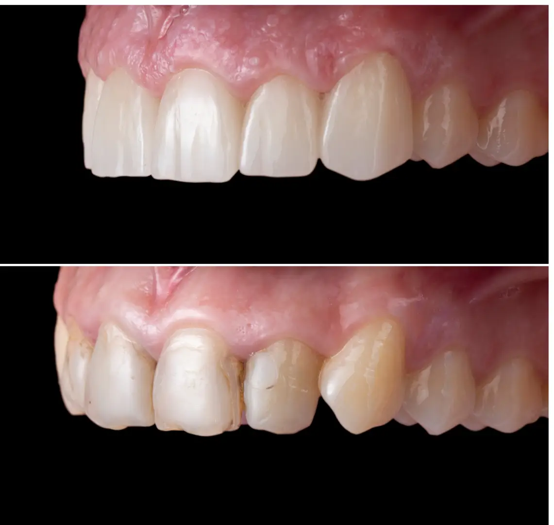 Protetika Praha - zubní korunky, zubní můstek a fixní zubní náhrady