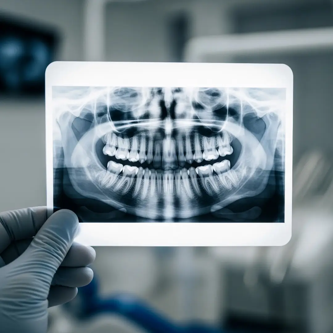 Konzervativní stomatologie Praha - ošetření kazu, vrtání zubu a zubní výplně